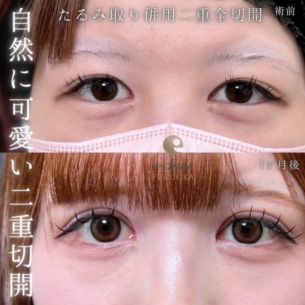 たるみ取り併用全切開の症例写真 (1)