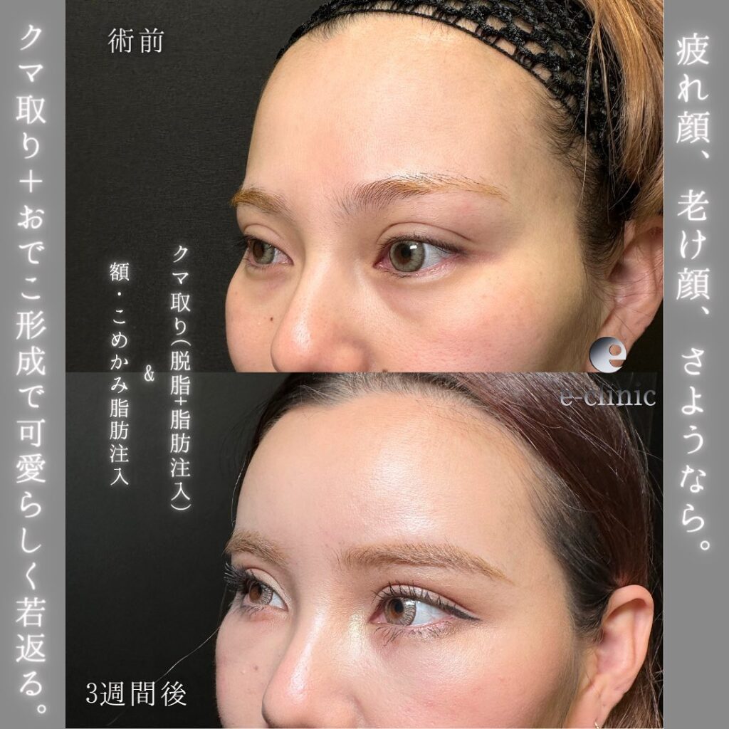 脱脂と脂肪注入と額とこめかみの脂肪注入の症例写真 (1)