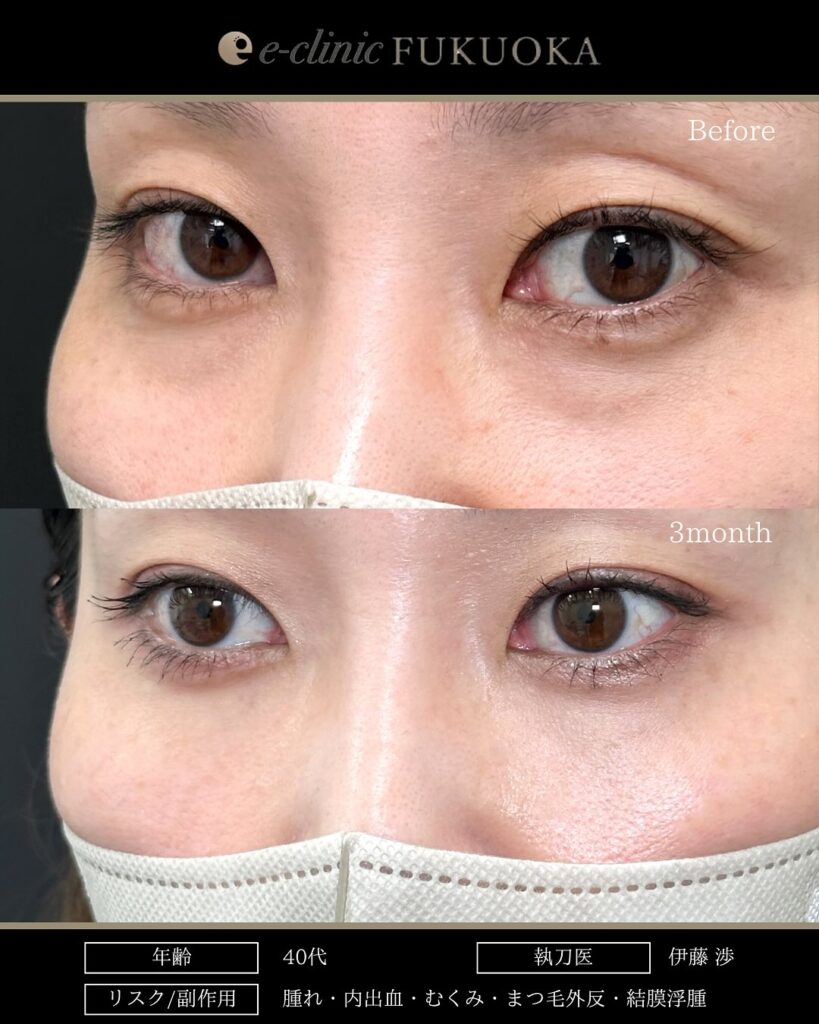 裏ハムラ法の症例写真 (99)