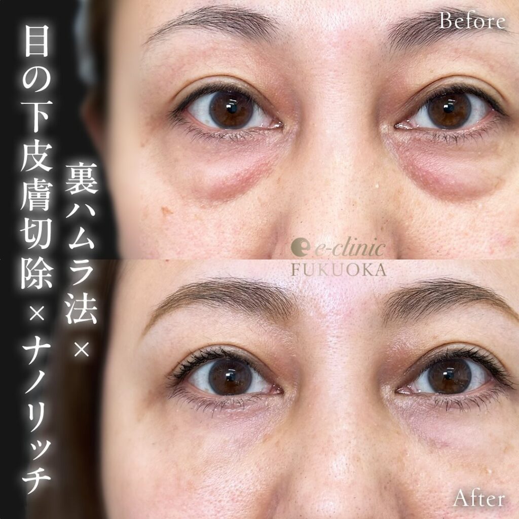 目の下のクマ取りと裏ハムラ法と目の下の脂肪注入の症例写真 (1)