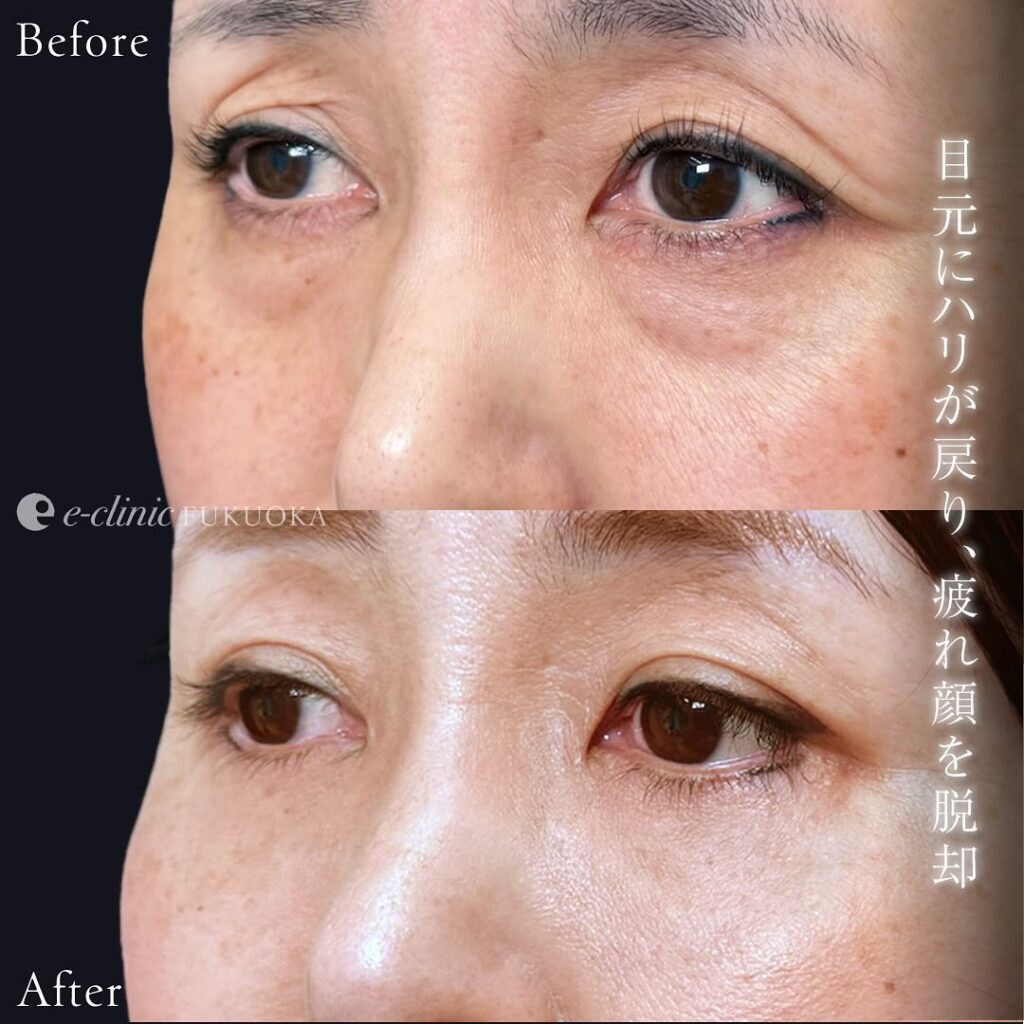 裏ハムラ法と目の下の脂肪注入と額とこめかみの脂肪注入の症例写真 (7)