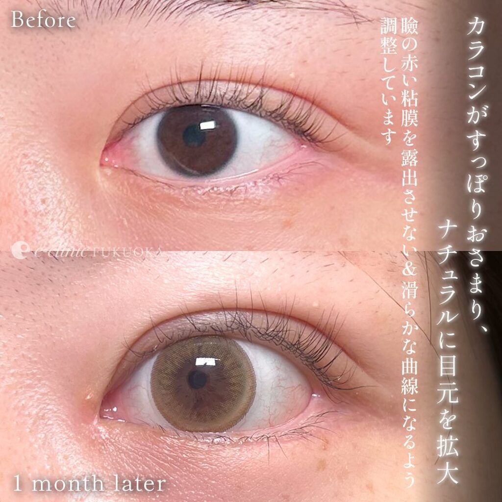 タレ目形と目頭切開と目尻切開の症例写真 (2)