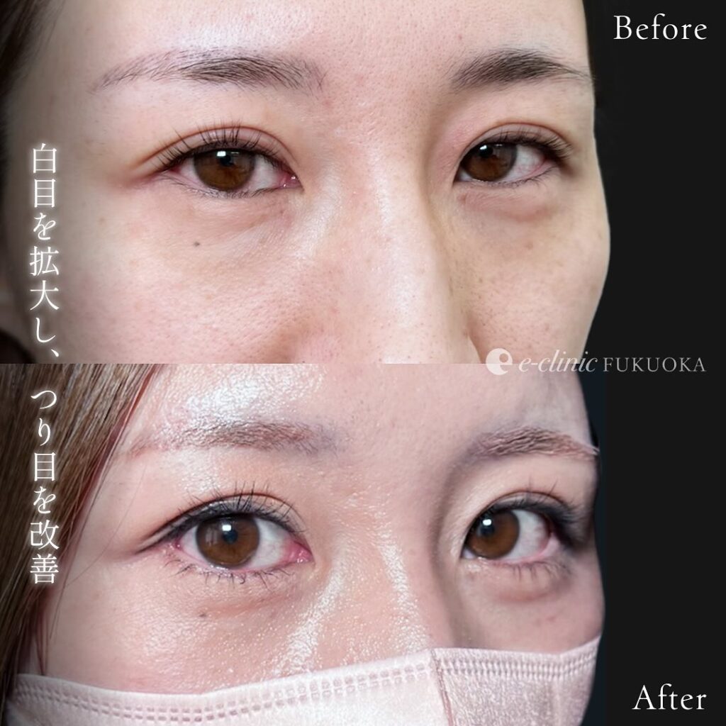 タレ目形成+目尻切開の症例写真 (3)