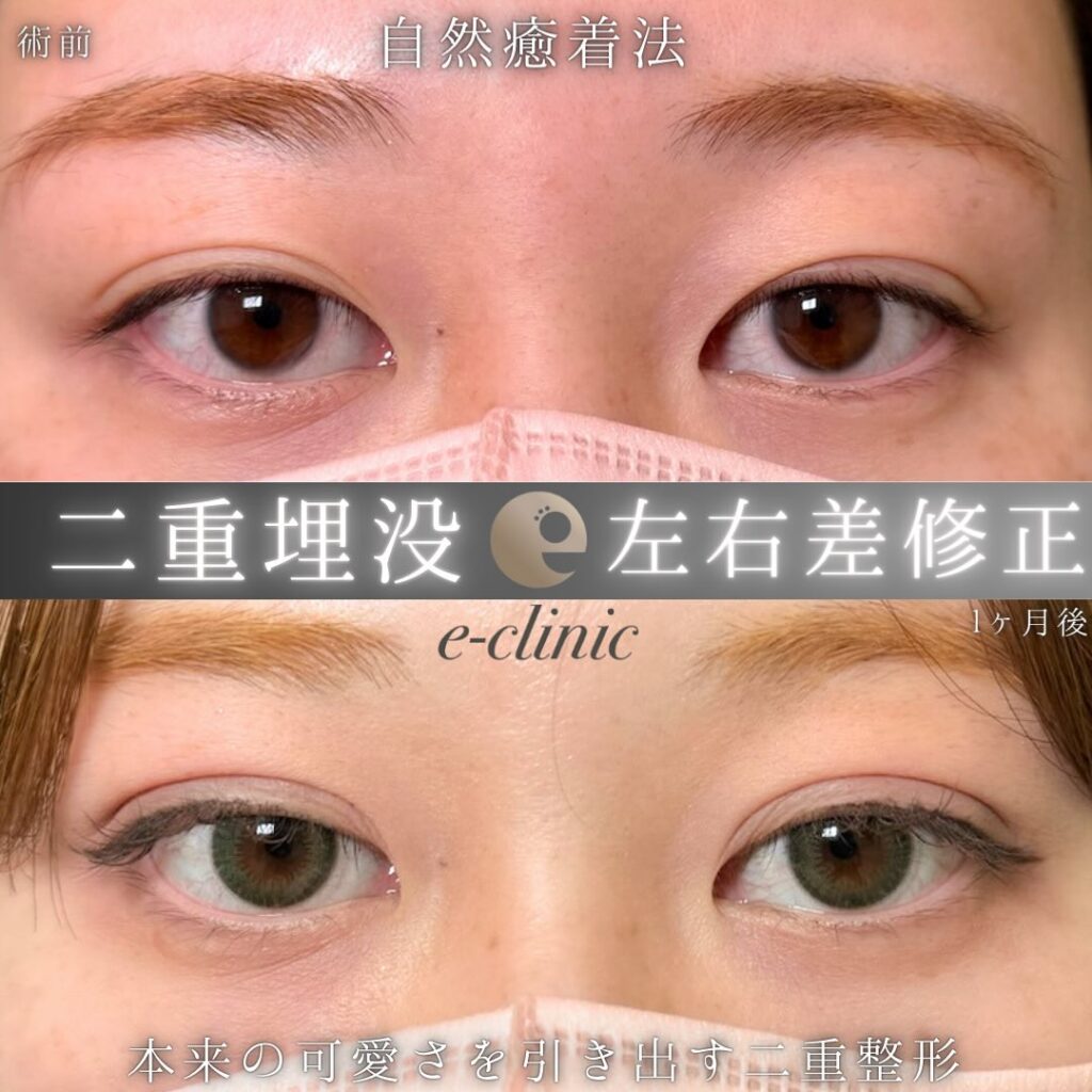 埋没法の症例写真 (9)