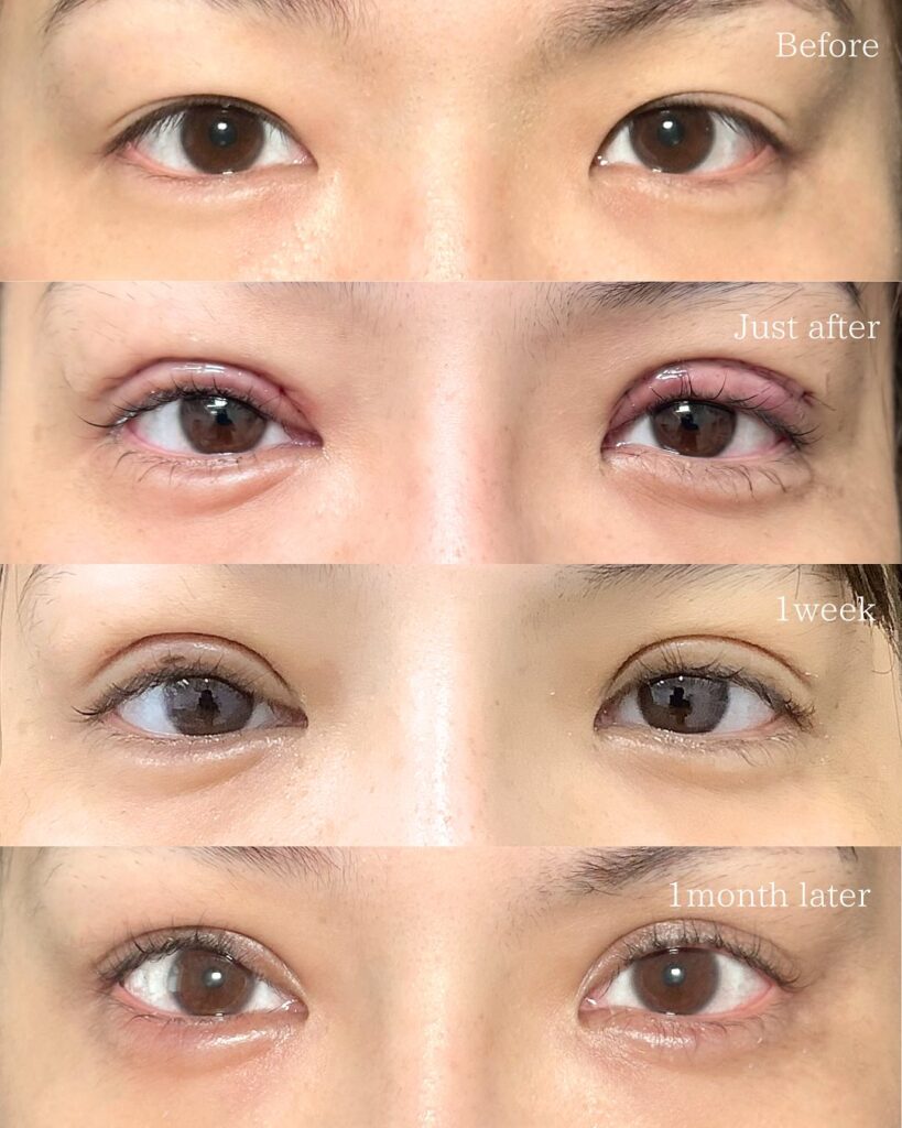 眼瞼下垂と全切開と涙袋のヒアルロン酸の症例写真 (2)