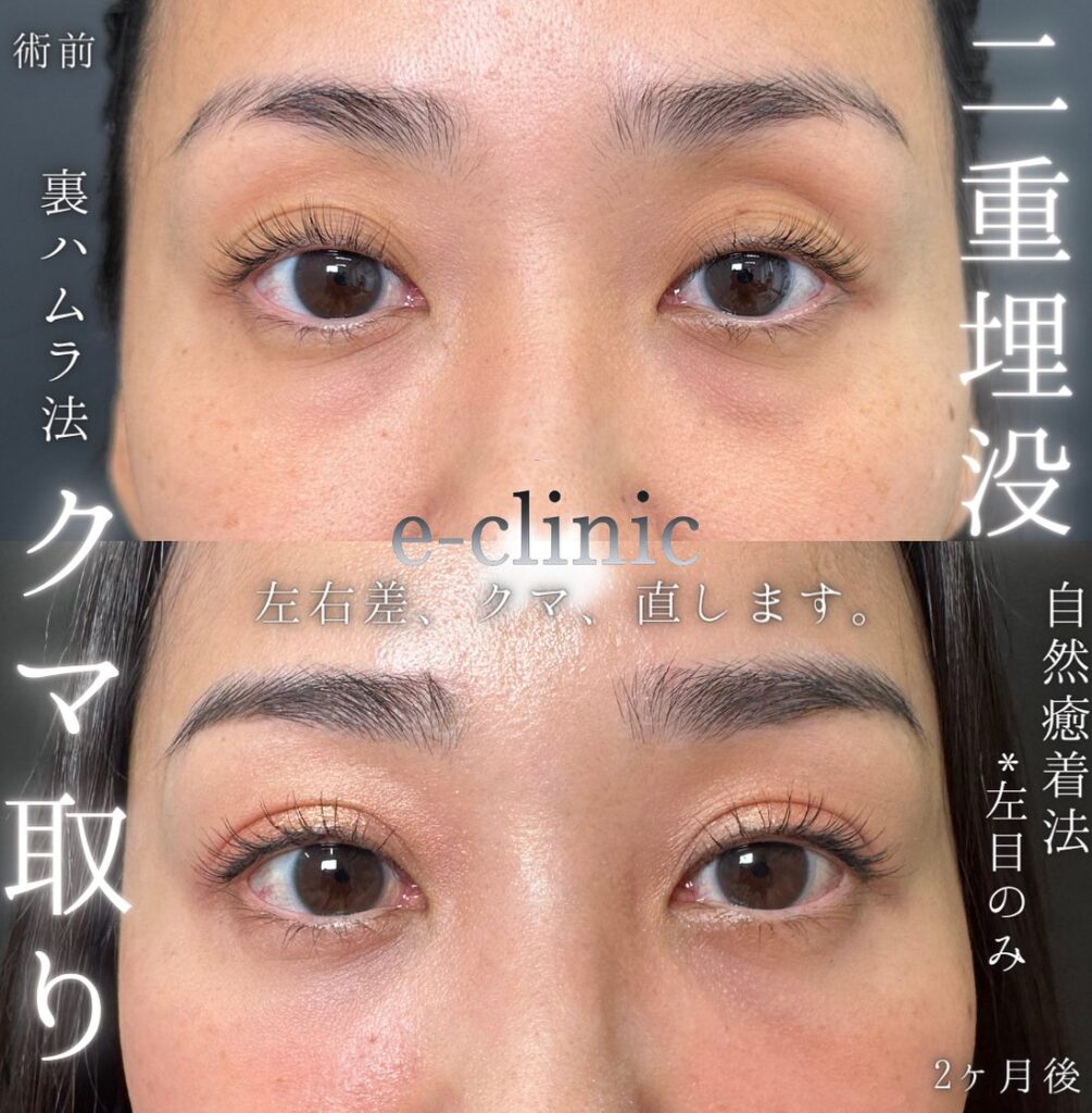 埋没法と裏ハムラ法の症例 (3)