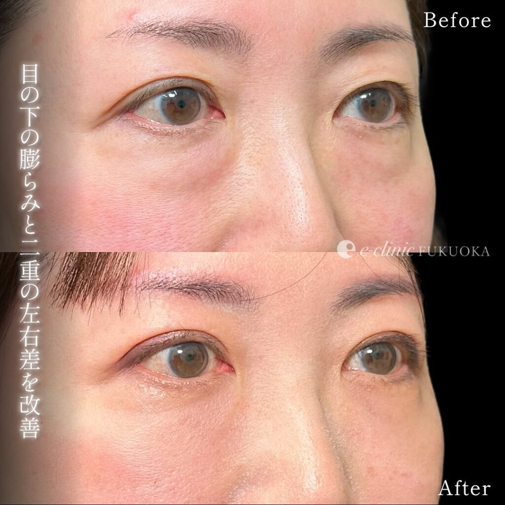 裏ハムラ法と埋没法の症例写真 (11)