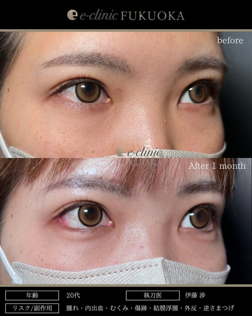 タレ目形成と目尻切開の症例写真 (14)