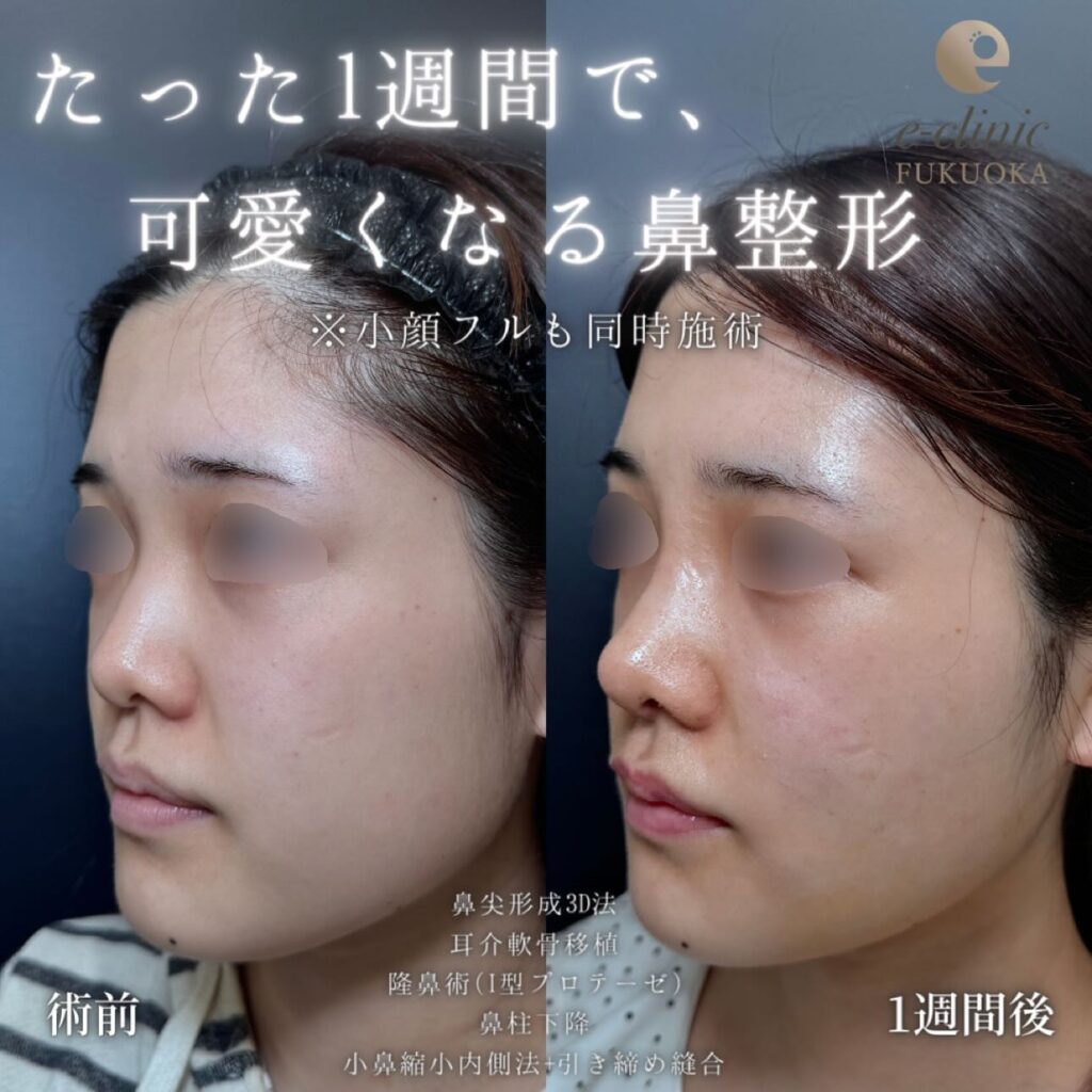 鼻尖形成と軟骨移植とプロテーゼと鼻柱下降と小鼻縮小と頬と顎下の脂肪吸引とバッカルファットと糸リフトの症例写真 (1)