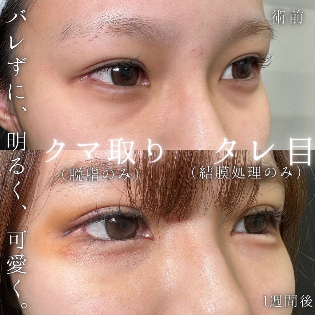 脱脂とタレ目形成の症例写真 (3)