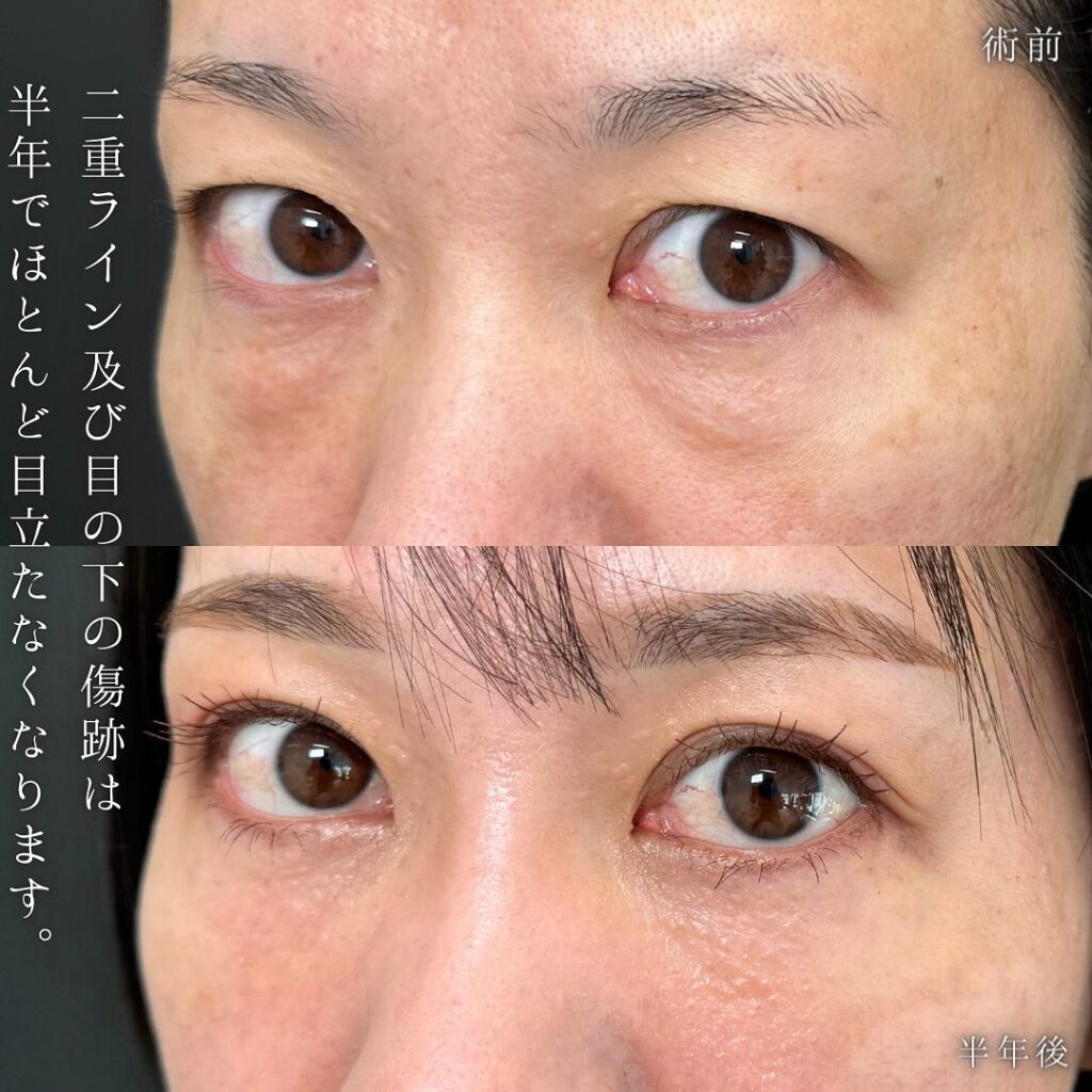 全切開と裏ハムラ法の症例写真 (2)