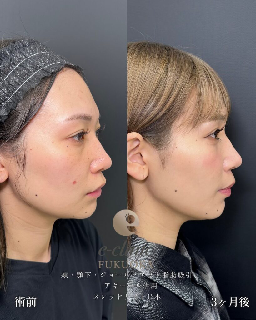 頬と顎下の脂肪吸引とジョールファットと糸リフトの症例写真 (2)