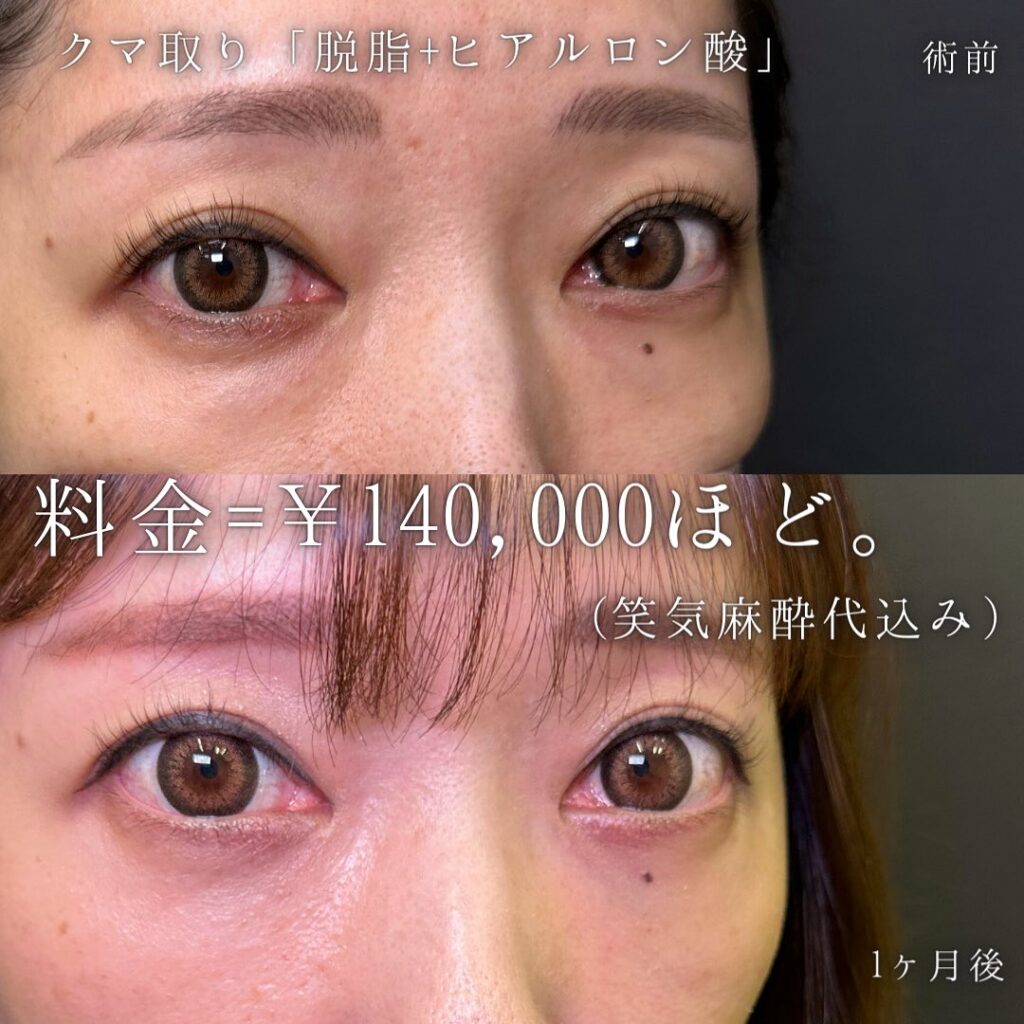 脱脂と目の下のヒアルロン酸の症例写真 (2)