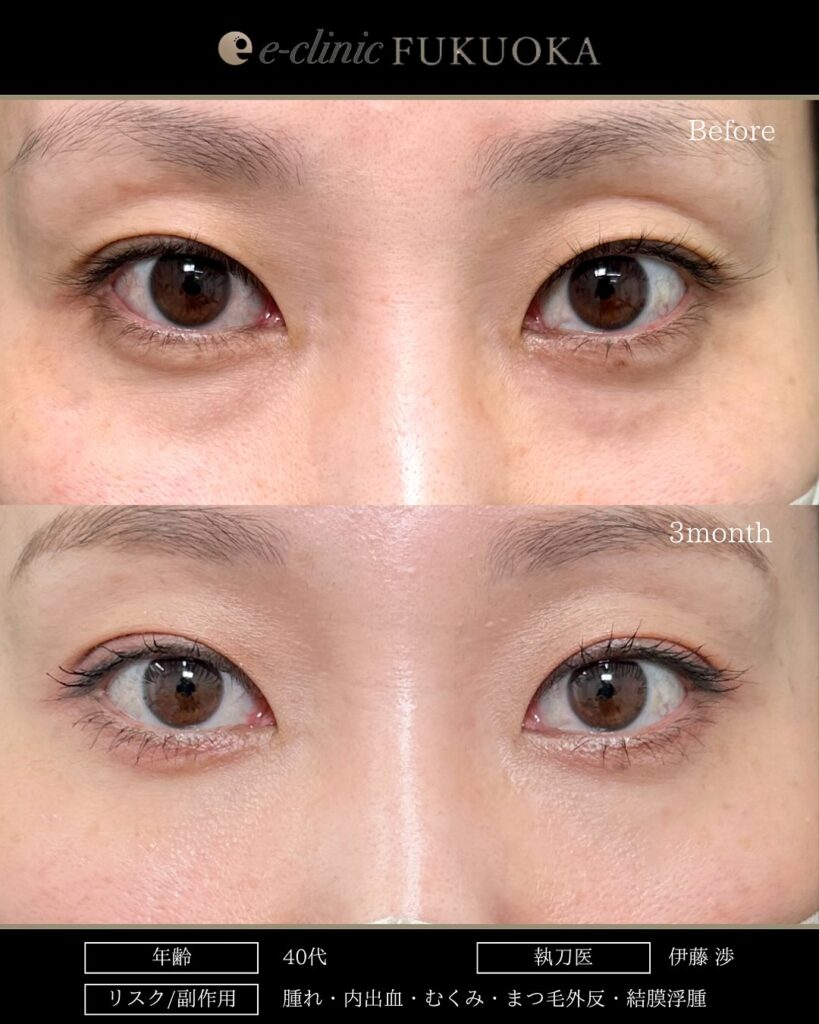 裏ハムラ法の症例写真 (100)