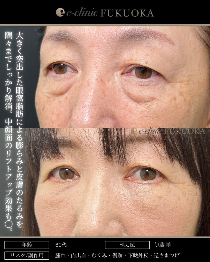 裏ハムラ法と脂肪注入の症例写真 (32)