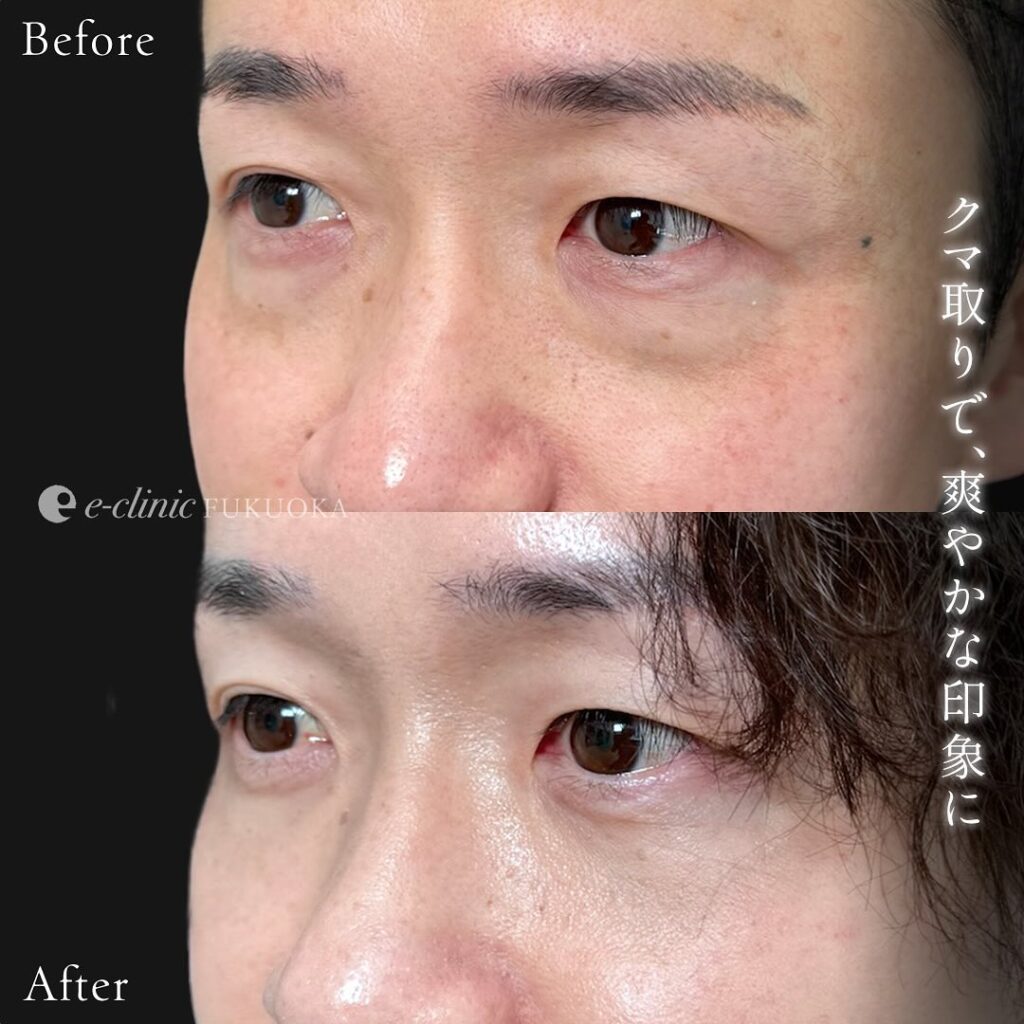 脱脂と脂肪注入の症例写真 (12)