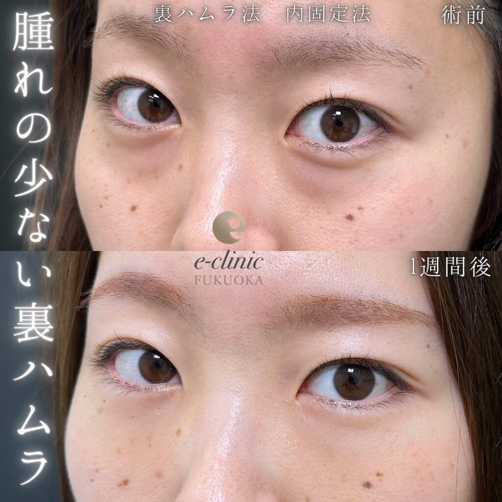 裏ハムラ法の症例写真 (73)