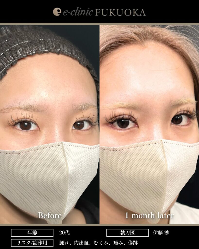 タレ目形成と目尻切開と埋没法の症例写真 (2)