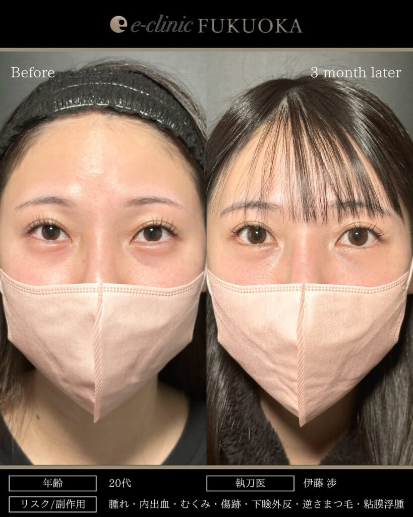 タレ目形成と目尻切開と脱脂と目の下の脂肪注入の症例写真 (2)