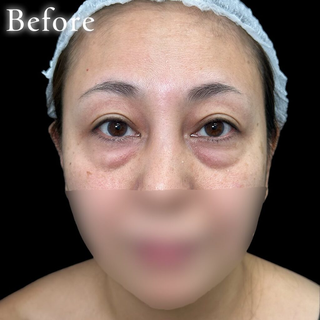 目の下のクマ取りと裏ハムラ法と目の下の脂肪注入の症例写真 (4)