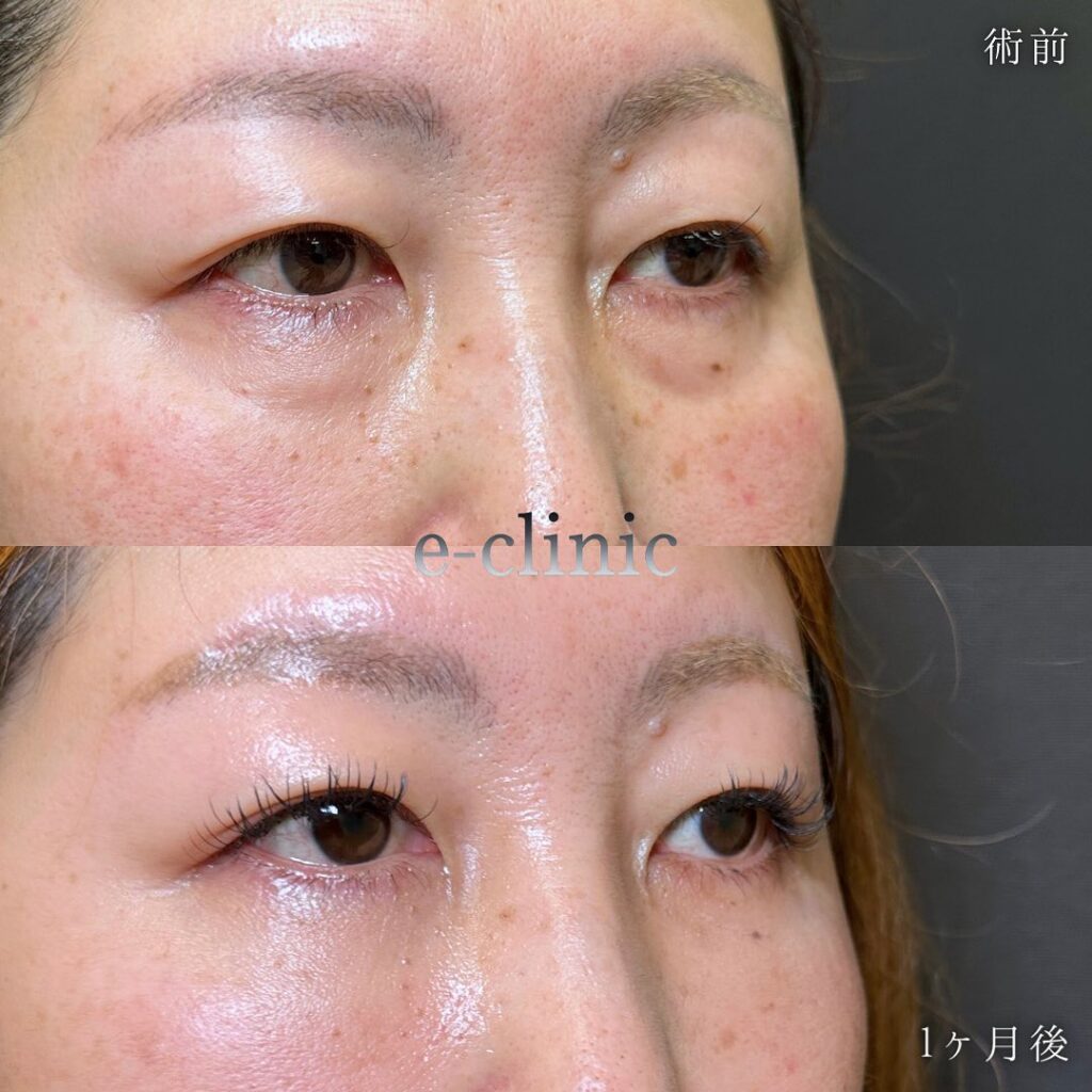 裏ハムラ法の症例写真 (21)