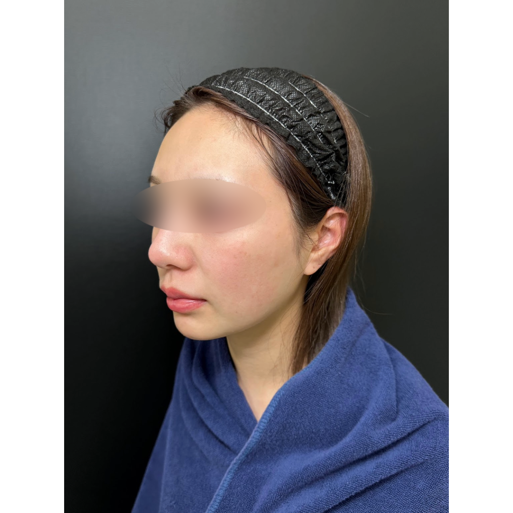 eクリニック福岡院の小顔脂肪吸引＋糸リフトの症例術前写真（名医の伊藤渉医師が執刀）・頬・顎下・ジョールファット脂肪吸引
・バッカルファット除去
・糸リフト（スレッドリフト8本）
