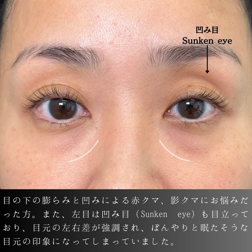 裏ハムラ法と埋没法の症例写真 (6)