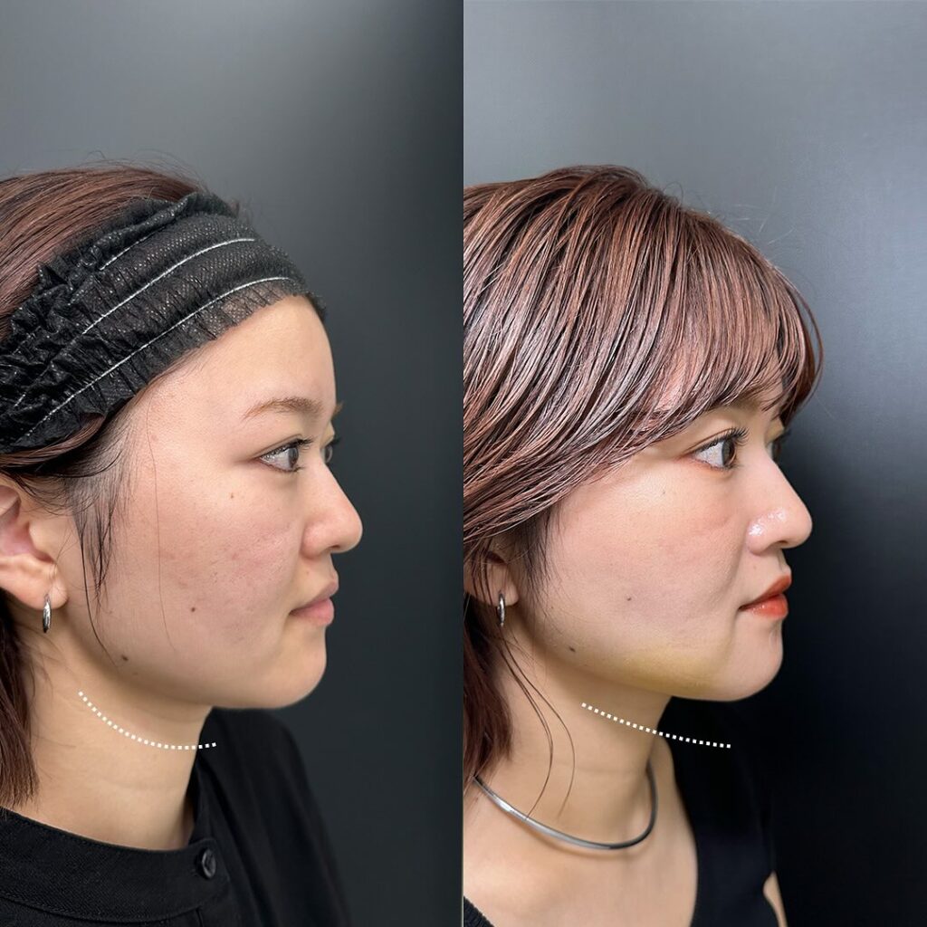 頬の脂肪吸引とジュールファットと糸リフトの症例写真 (3)