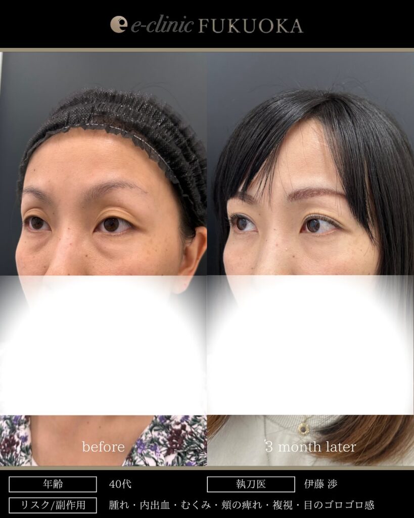 裏ハムラ法と埋没法の症例写真 (14)