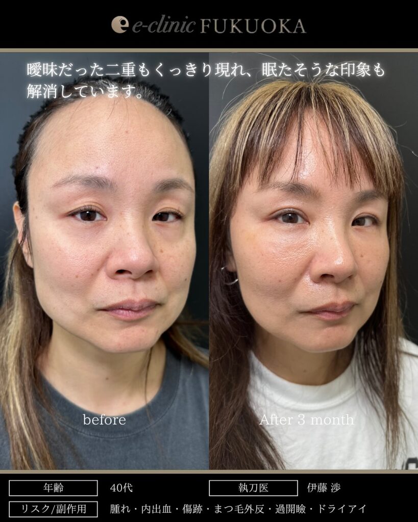 全切開と眼瞼下垂の症例写真 (2)