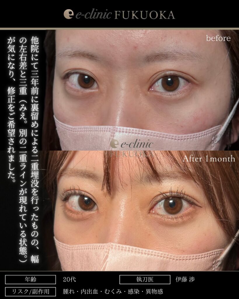 他院埋没裏留め抜糸と埋没法の症例写真 (2)