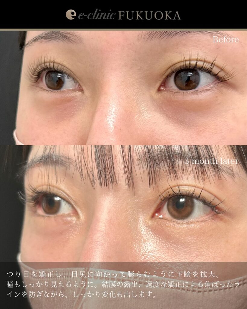 タレ目形成と目尻切開と脱脂と目の下の脂肪注入の症例写真 (3)