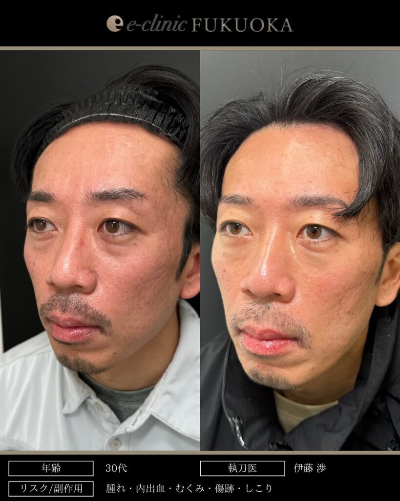 裏ハムラ法と脂肪注入の症例写真 (35)