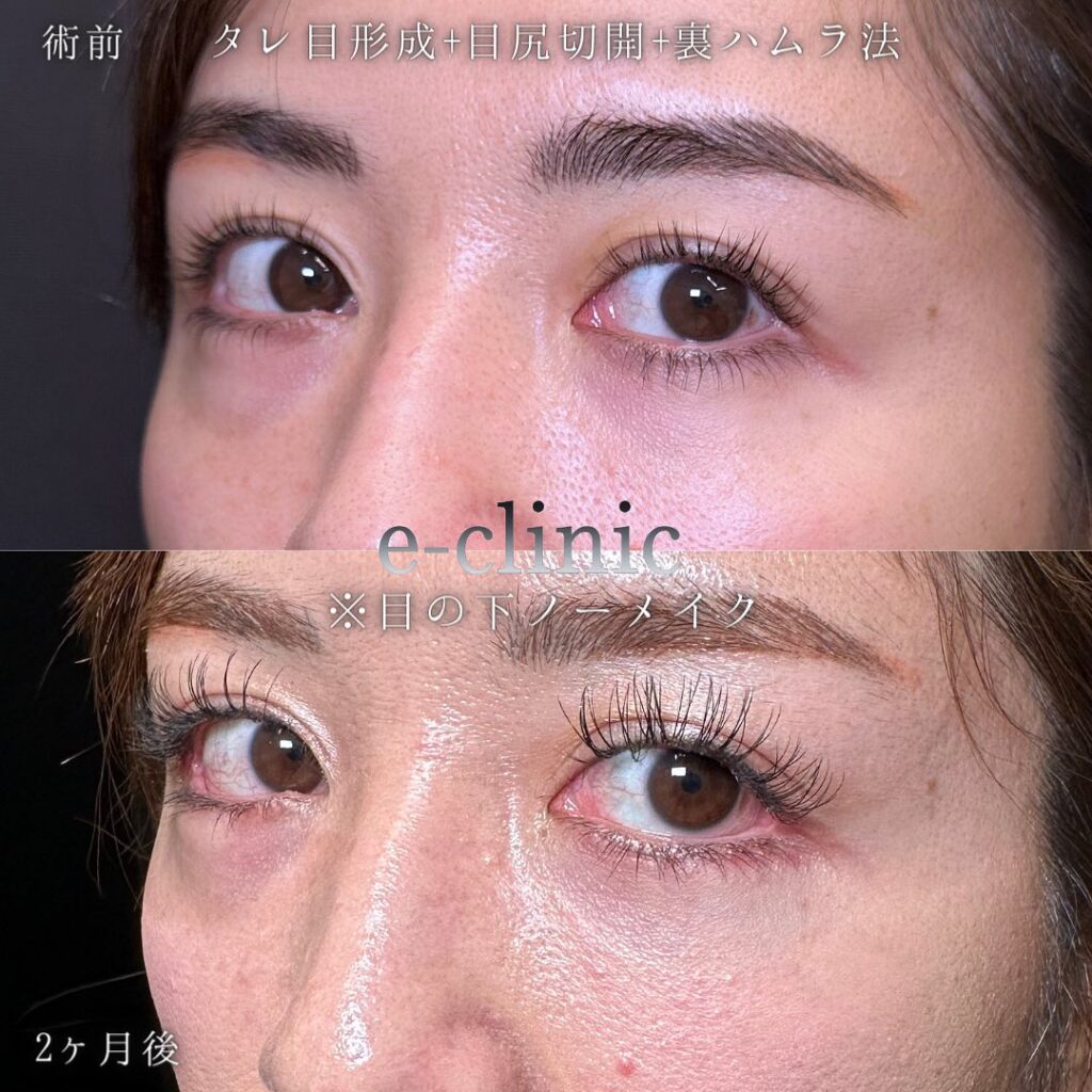 目尻切開とタレ目形成と裏ハムラ法の症例写真 (2)