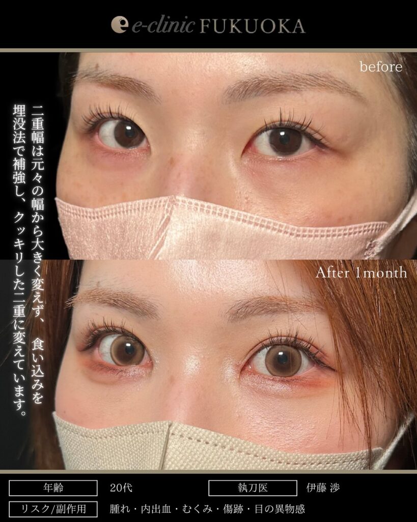 埋没法と目頭切開の症例写真 (2)