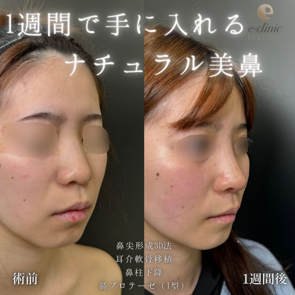 鼻尖形成と軟骨移植とプロテーゼと鼻柱下降の症例写真 (3)