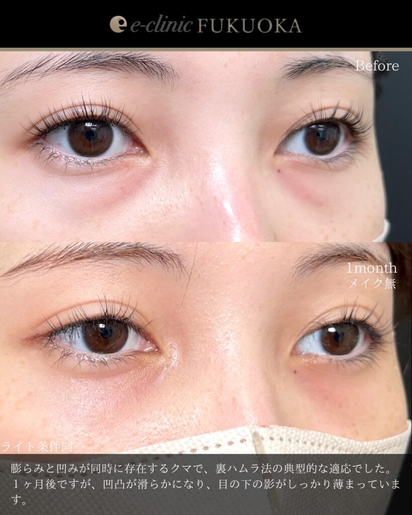 裏ハムラ法の症例写真 (105)