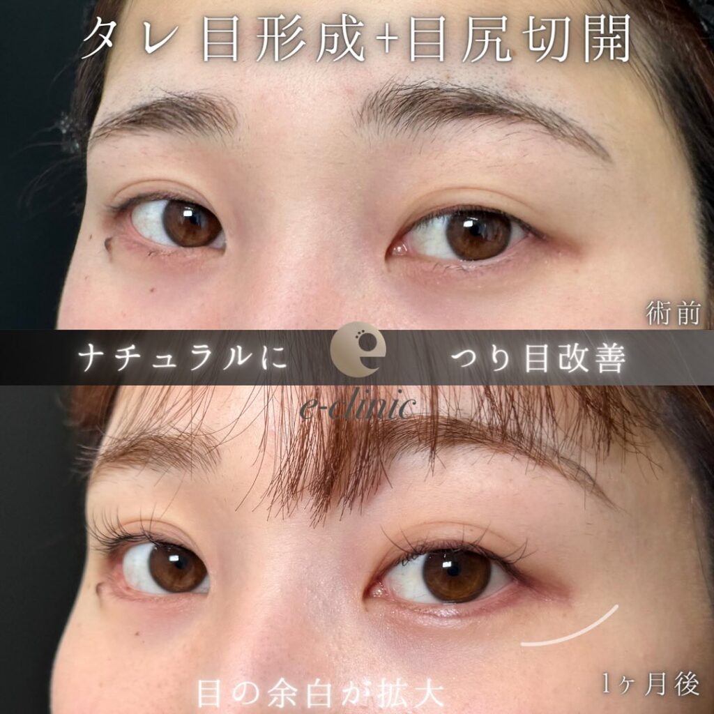 タレ目形成と目尻切開の症例写真 (4)