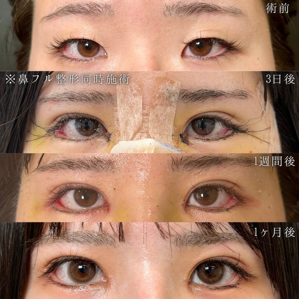 目の全方向拡大術の症例写真 (2)