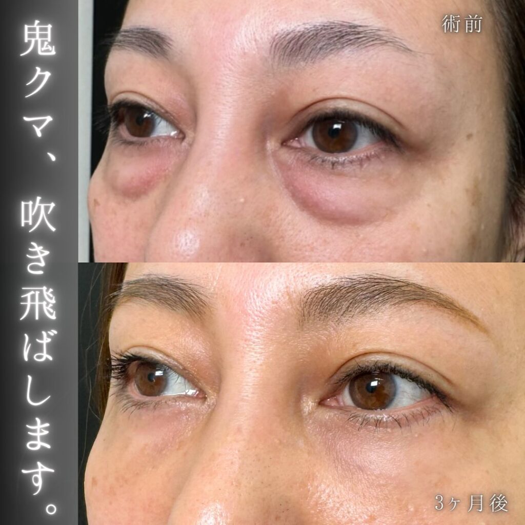 裏ハムラ法と脂肪注入の症例写真 (14)