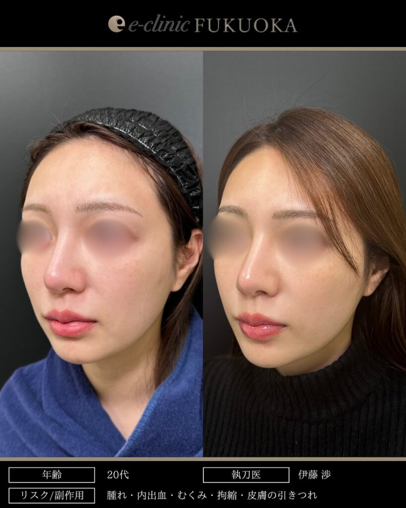 頬と顎下の脂肪吸引とジョールファットとバッカルファットと糸リフトの症例写真 (5)