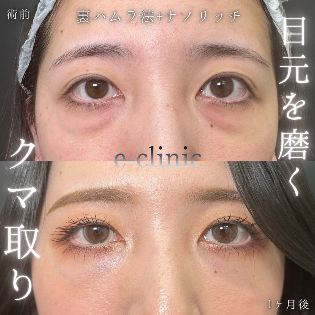 裏ハムラ法と脂肪注入の症例写真 (12)