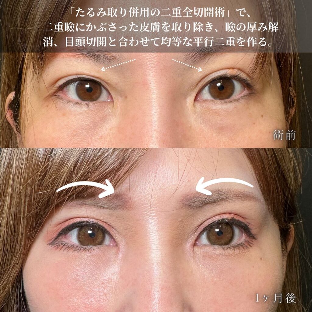 目の全方向拡大とクマ取りの症例写真 (5)