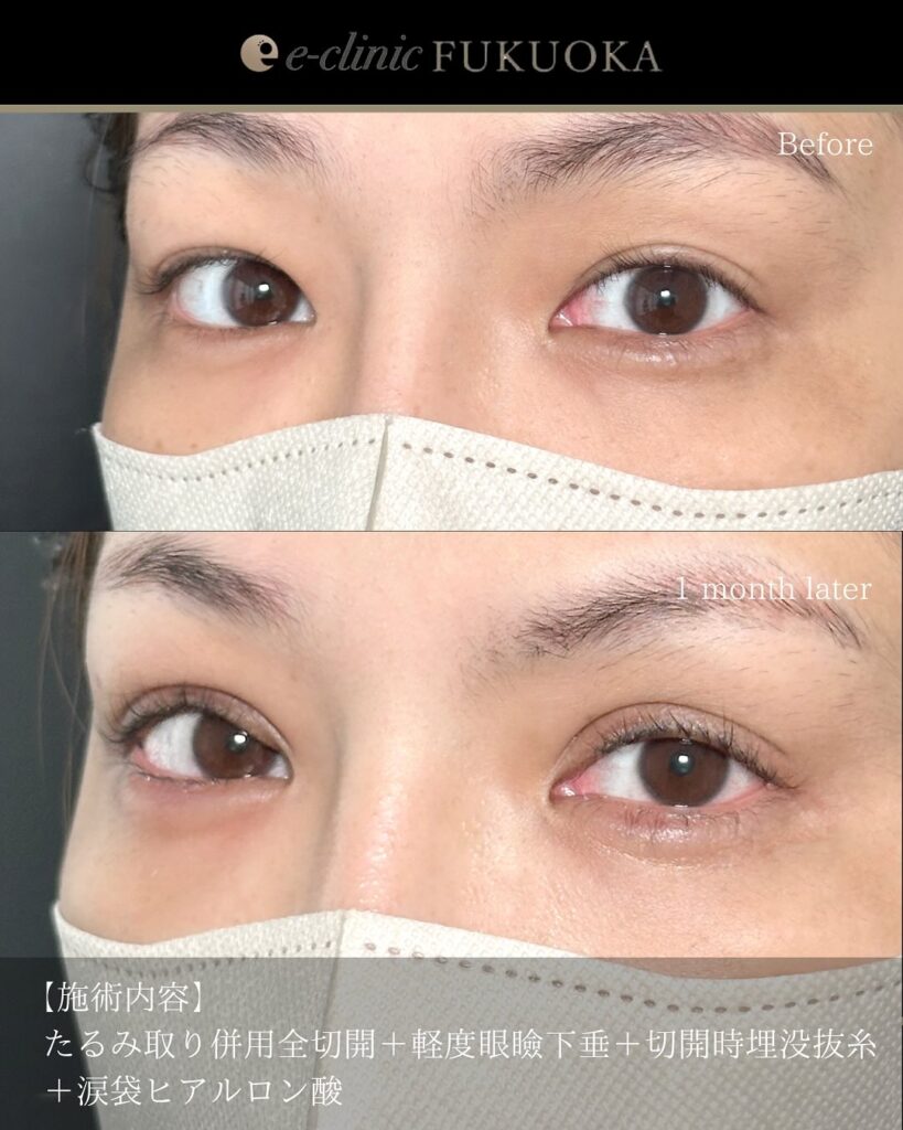 眼瞼下垂と全切開と涙袋のヒアルロン酸の症例写真 (3)