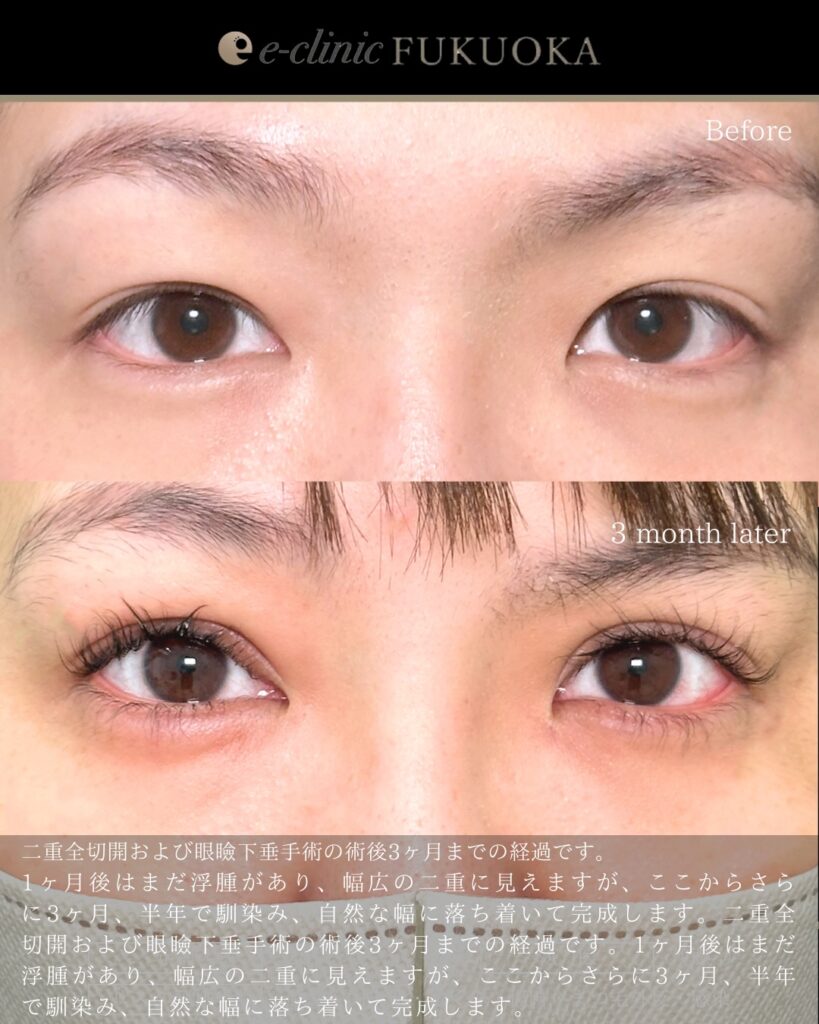 たるみとり併用全切開と眼瞼下垂と涙袋のヒアルロン酸の症例写真 (5)