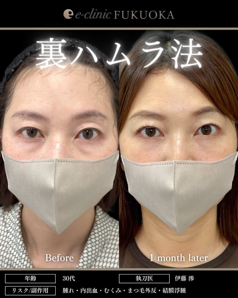 裏ハムラ法の症例写真 (91)