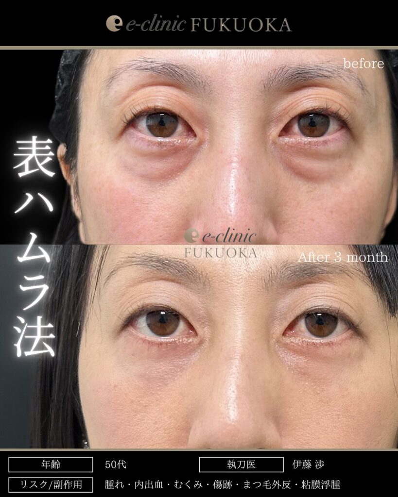 裏ハムラ法の症例写真 (91)