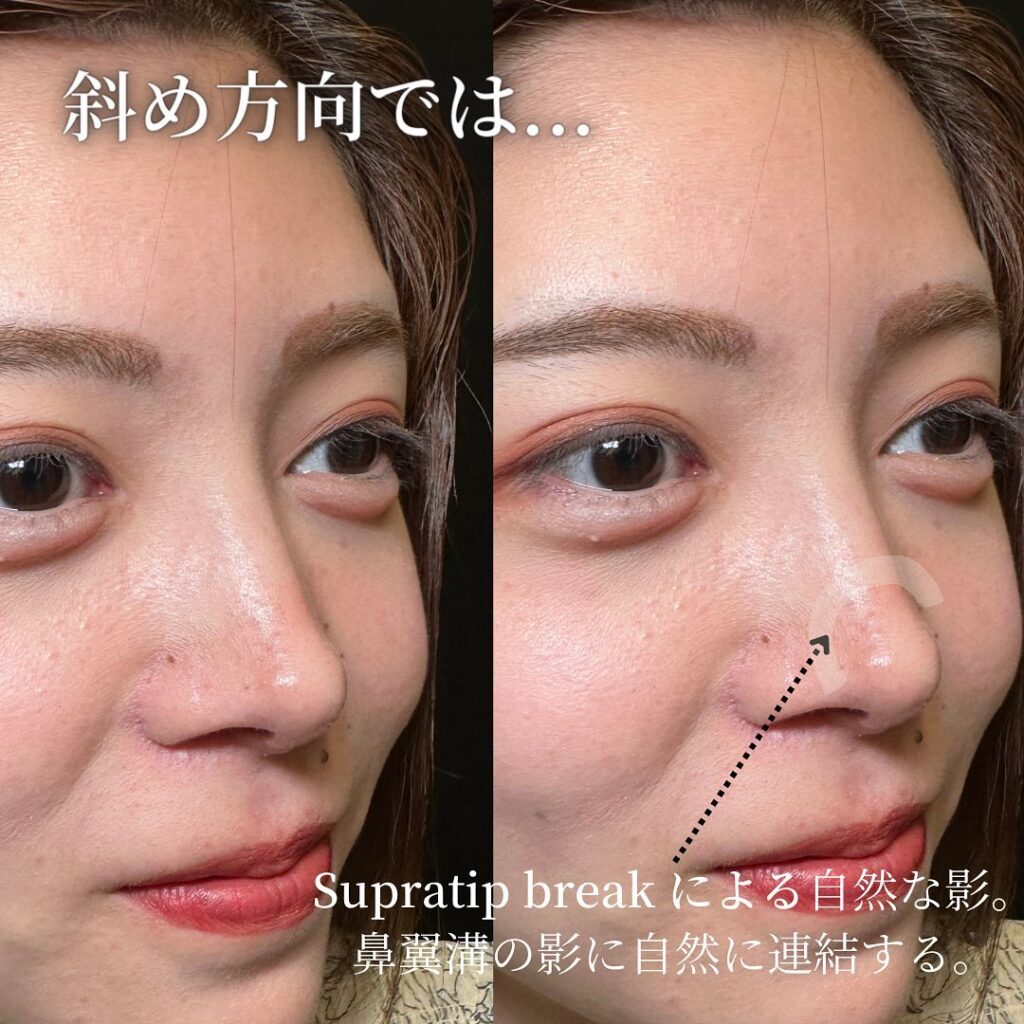 鼻中隔延長と鼻尖形成と耳介軟骨移植とプロテーゼと他院修正の症例写真 (2)