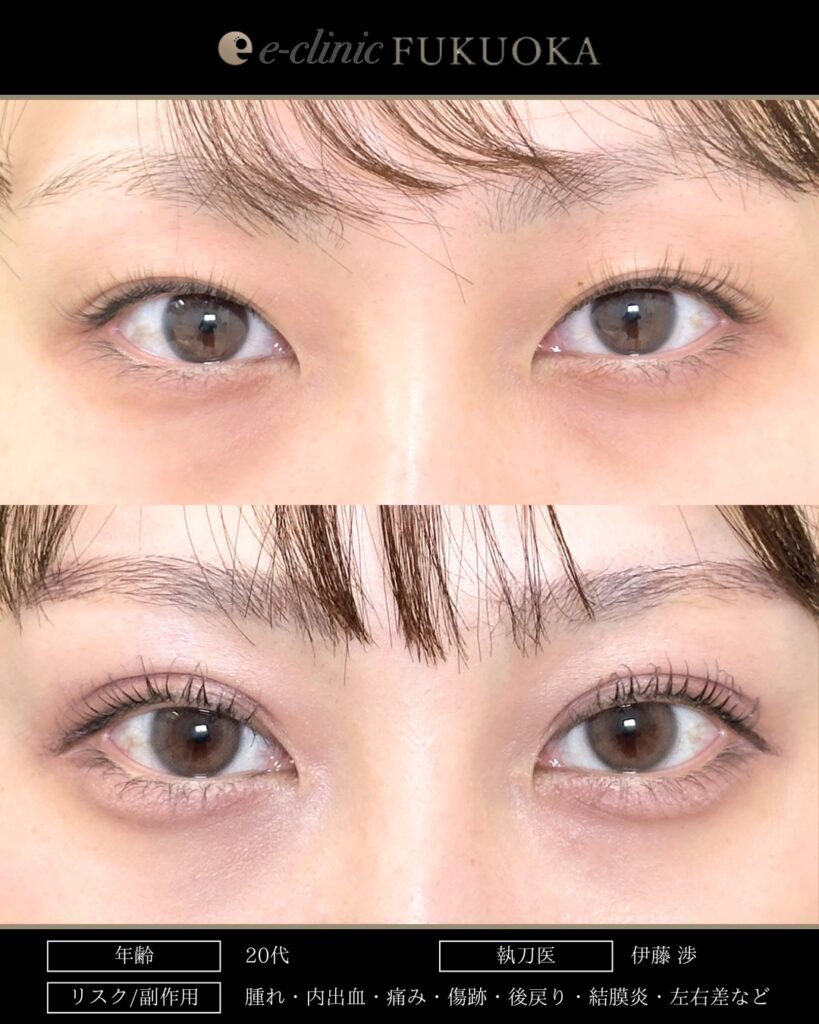 埋没法の症例写真 (13)