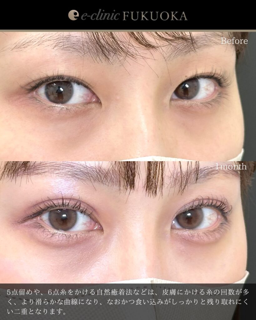 埋没法の症例写真 (16)